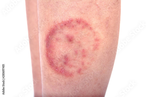 Closeup of ringworm infection or Tinea corporis on skin isolated on white background,  Dermatophytosis on skin isolated