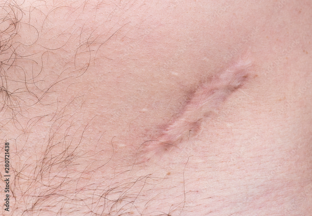 Fototapeta premium Scar on human skin scar or cicatrice after operation on stomach