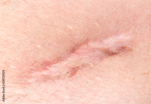 Scar on human skin scar or cicatrice after operation on stomach