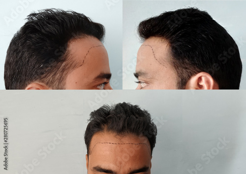 Εκτύπωση καμβά Receding hairline in men. hair loss
