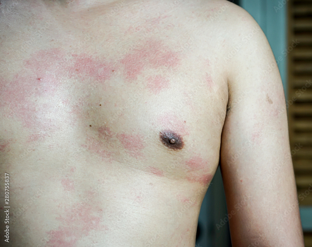 Fototapeta premium ringworm and fungal skin on the body