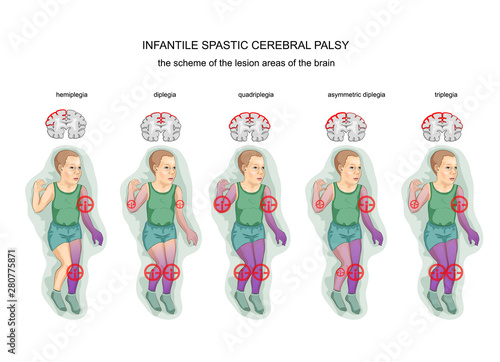 Spastic Infantile Cerebral Palsy Stock Vektorgrafik Adobe Stock