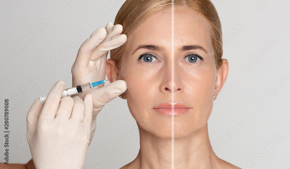 Injection for aged woman with syringe for both parts of face