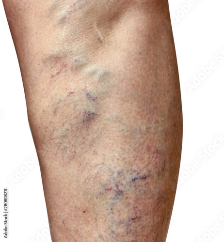 Varicose veins on a female legs. Phlebology