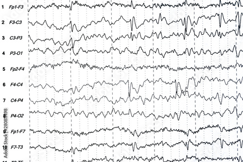 Brain wave patterns on electroencephalogram, EEG of the pediatric patients, problems in the electrical activity of the brain. photo