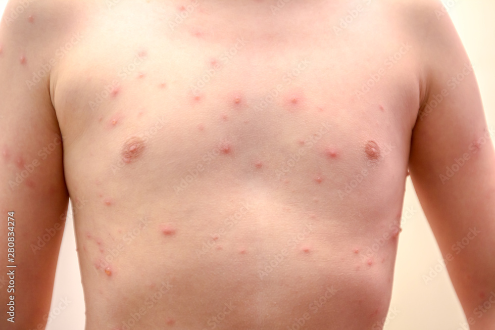 Child skin infected with chickenpox Child skin infected with chickenpox