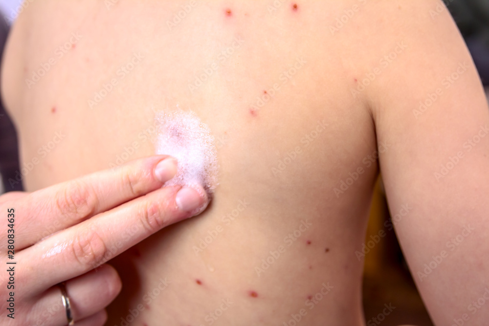Therapy against the virus of Varicella has measles, chicken pox, rubella Therapy against the virus of Varicella has measles, chicken pox, rubella