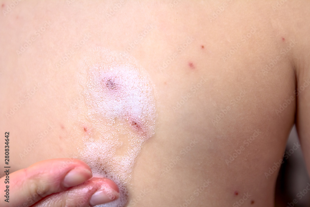 Therapy against the virus of Varicella has measles, chicken pox, rubella Therapy against the virus of Varicella has measles, chicken pox, rubella