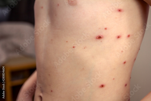 Child skin infected with chickenpox photo