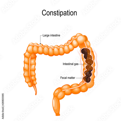 Constipation. human large intestine with fecal matter