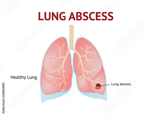 Lungs abscess, lungs disease, isolated vector illustration on White background.