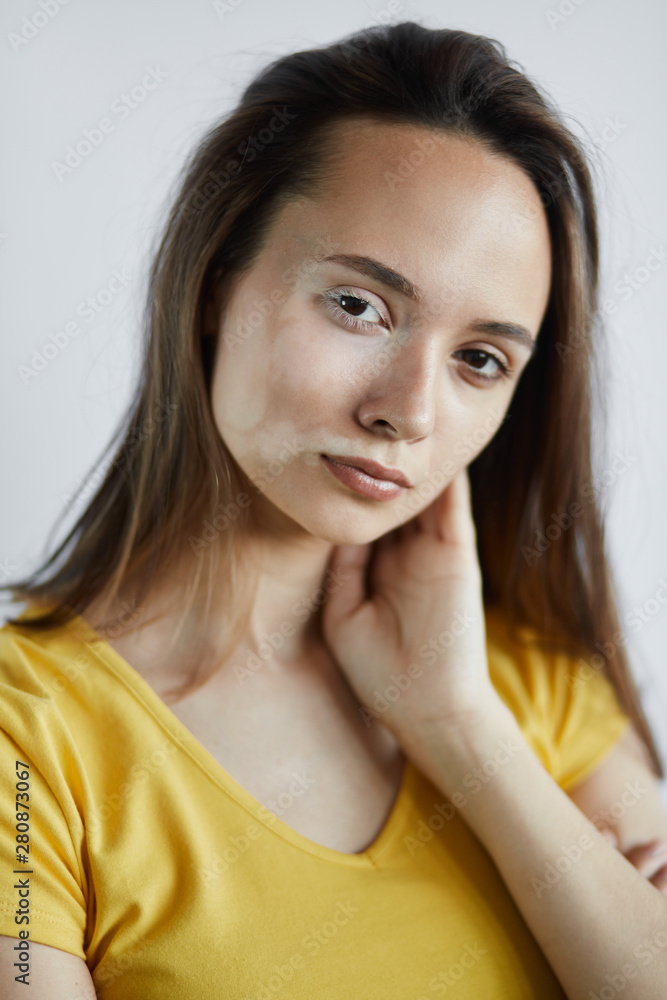attractive sad unhappy girl has skin desease after thermal injuries, injections, insect bites. close up photo attractive sad unhappy girl has skin desease after thermal injuries, injections, insect bites. close up photo