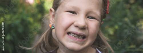 Child with a dental orthodontic device and without one tooth
