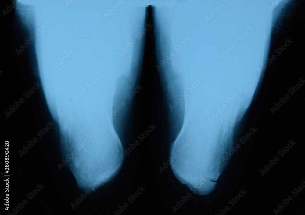 Obraz premium X-ray of feet and heel bones. X ray picture of bones.
