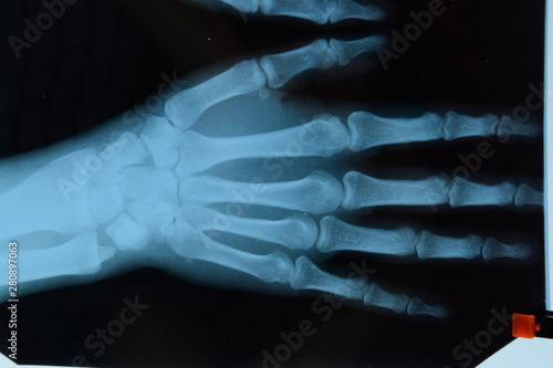 X ray of the hands, a picture of the bones of the hands on the x-ray.