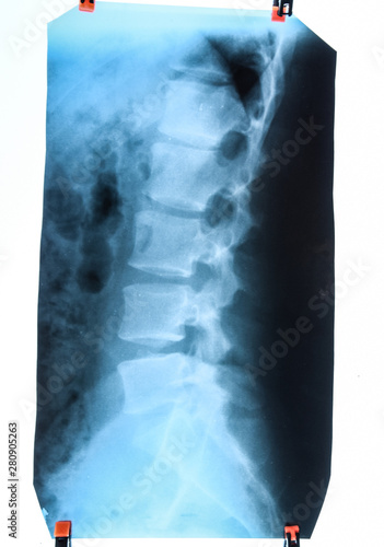 X ray of the lumbar spine, spine on x-ray photo