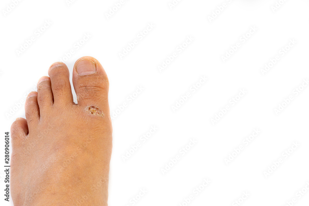 Dermatitis, ill allergic rash dermatitis or eczema skin on the legs over white background Dermatitis, ill allergic rash dermatitis or eczema skin on the legs over white background