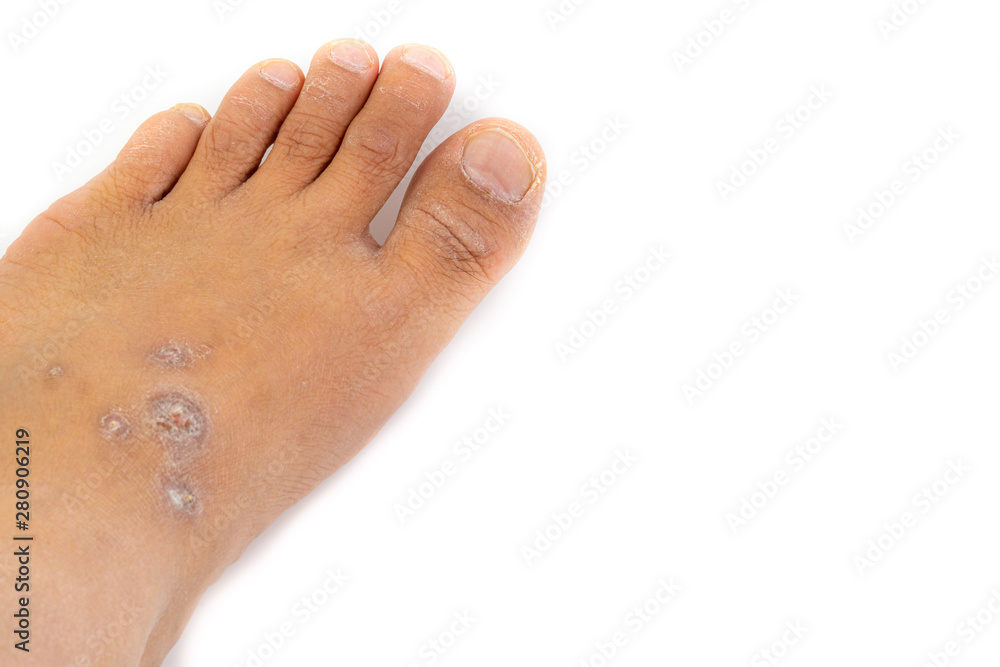 Dermatitis, ill allergic rash dermatitis or eczema skin on the legs over white background Dermatitis, ill allergic rash dermatitis or eczema skin on the legs over white background