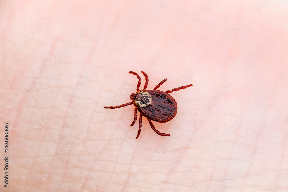 Encephalitis Virus or Lyme Borreliosis Disease Infectious Dermacentor Tick Arachnid Parasite Insect on Skin Macro Encephalitis Virus or Lyme Borreliosis Disease Infectious Dermacentor Tick Arachnid Parasite Insect on Skin Macro