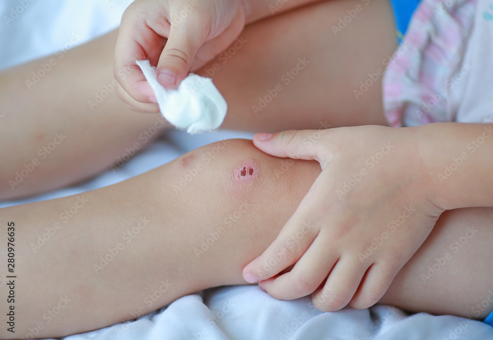 Close Up of child girl dressing wound on knee by self on the bed. Close Up of child girl dressing wound on knee by self on the bed.