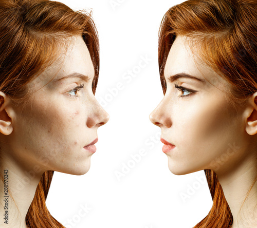 Young woman before and after skin treatment and makeup.