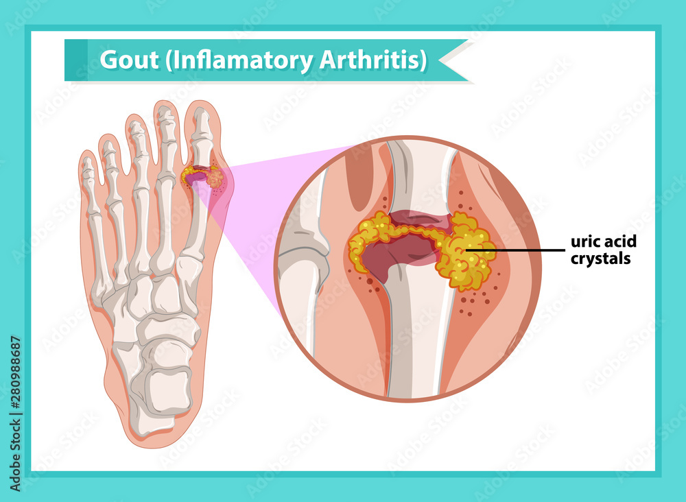 Scientific medical illustration of gout arthritis Stock Vector | Adobe ...