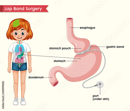Scientific medical illustration of lap band process