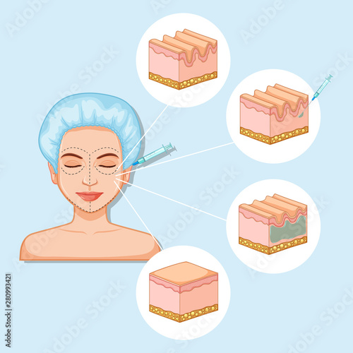 Scientific medical illustration of botox injection