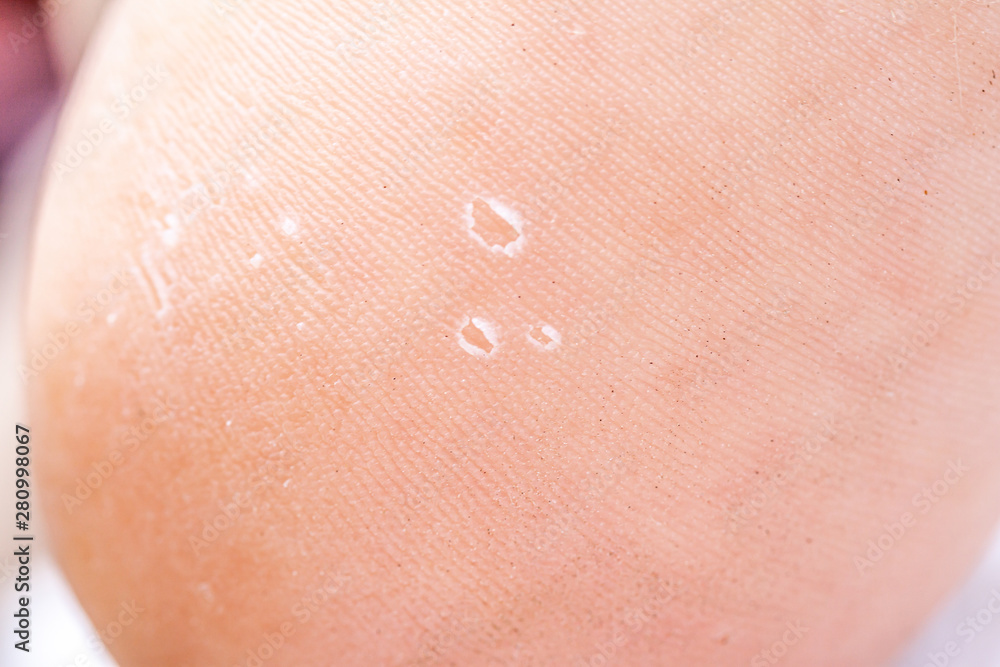 After the red rash and the strawberry tongue caused by scarlet fever the affected skin often peels - Here Skin of foot peeling After the red rash and the strawberry tongue caused by scarlet fever the affected skin often peels - Here Skin of foot peeling