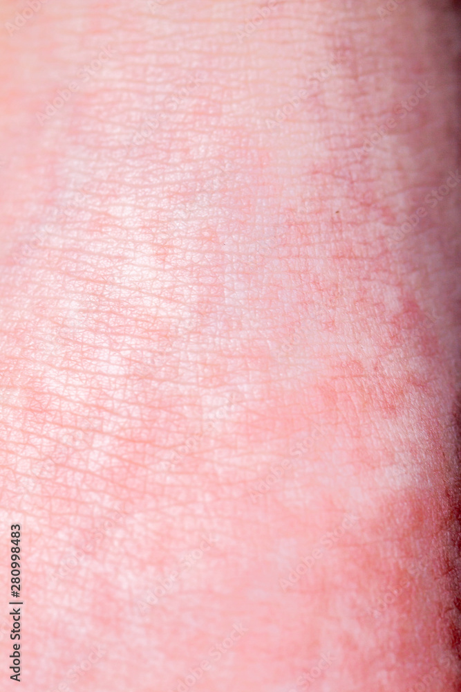 Fototapeta premium Scarlet Fever starts with a red rush and the strawberry tongue Afterwards the affected skin often peels - Here red skin rush