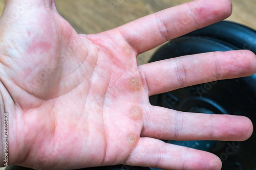 Hand with corn, callus, callosity, induration, congelation on the palm because of physical activity sports