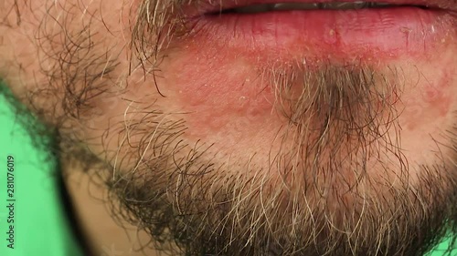 human scratches  his chin with red allergic reaction, redness and peeling psoriasis on face skin near lips, seasonal dermatology problem, close-up macro 