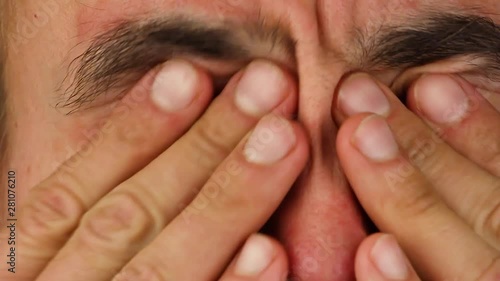 human scratches  two of his eyes with red allergic reaction, redness and peeling psoriasis on face skin, seasonal dermatology problem, close-up  