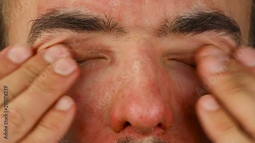 man blinks his eyes with red allergic reaction and scratches , redness and peeling psoriasis on face skin, seasonal dermatology problem, close-up  