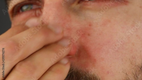 man scratches his nose with red allergic reaction, redness and peeling psoriasis on face skin, seasonal dermatology problem, side view close-up macro 