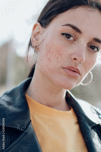 Close up portrait of young woman with acne