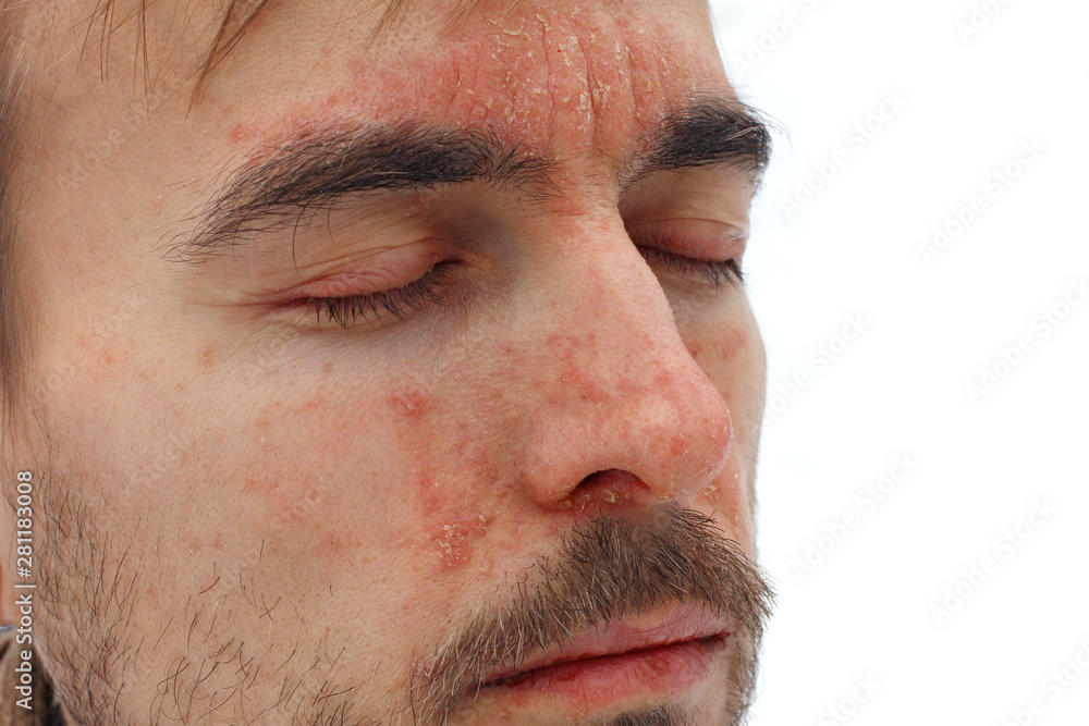 head of sick man with closed eyes with red allergic reaction on facial skin, redness and peeling psoriasis on nose, forehead and cheeks, seasonal skin problem, side view, white background head of sick man with closed eyes with red allergic reaction on facial skin, redness and peeling psoriasis on nose, forehead and cheeks, seasonal skin problem, side view, white background