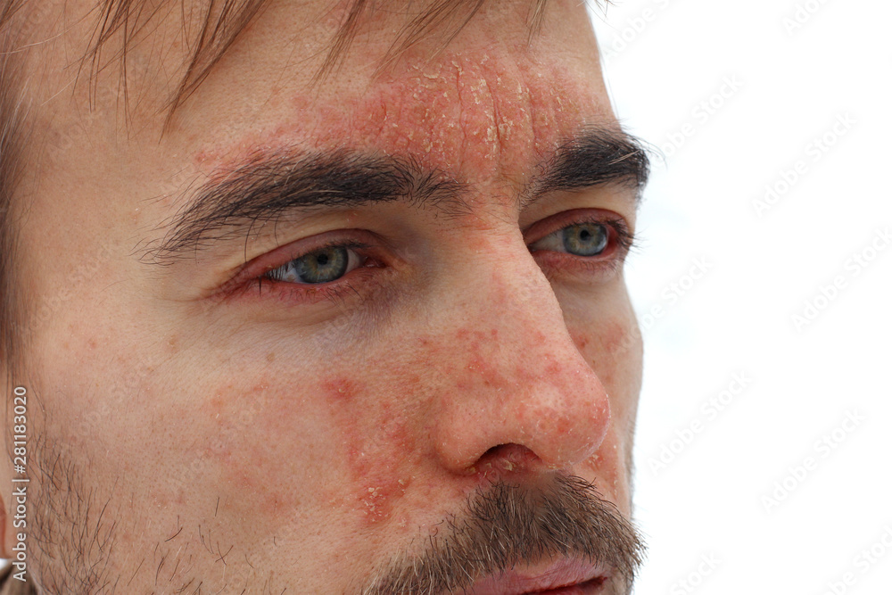 head of sick man with red allergic reaction on facial skin, redness and ...