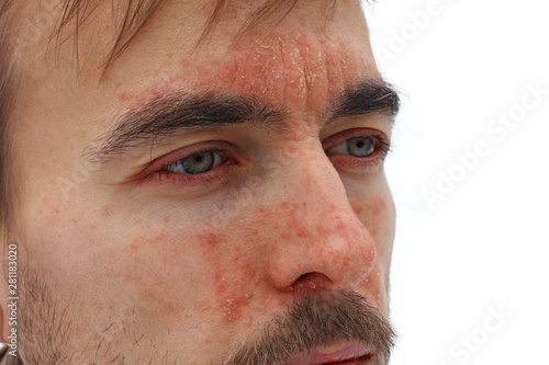 head of sick man with red allergic reaction on facial skin, redness and peeling psoriasis on nose, forehead and cheeks, seasonal skin problem, side view, white background