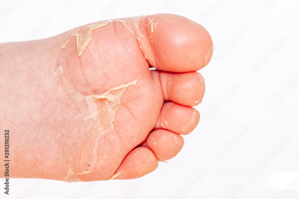 After the red rash and the strawberry tongue caused by scarlet fever the affected skin often peels - Here Skin of foot peeling After the red rash and the strawberry tongue caused by scarlet fever the affected skin often peels - Here Skin of foot peeling
