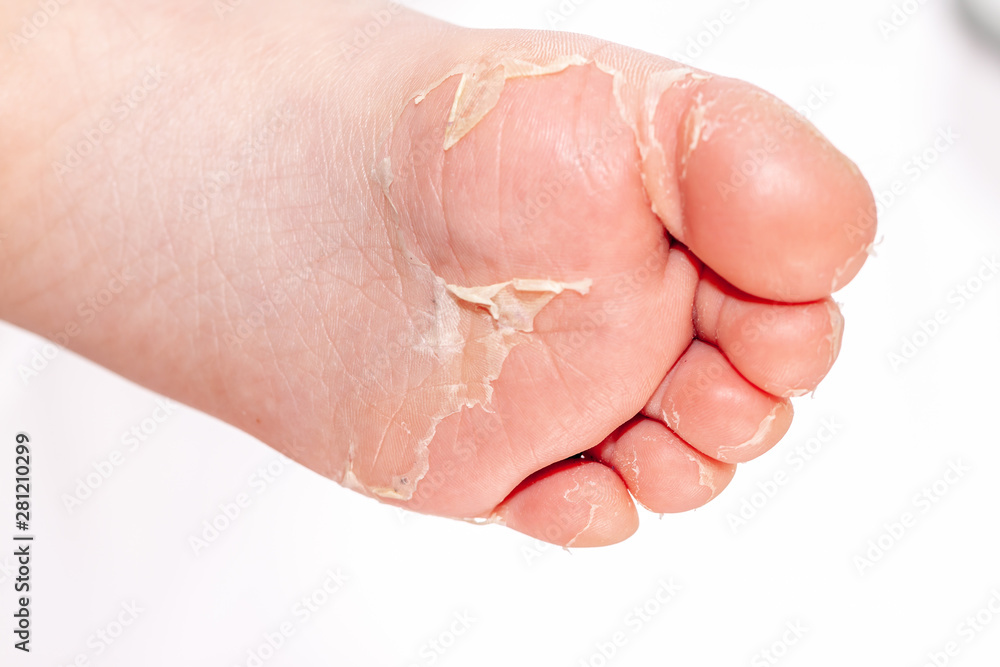After the red rash and the strawberry tongue caused by scarlet fever the affected skin often peels - Here Skin of foot peeling After the red rash and the strawberry tongue caused by scarlet fever the affected skin often peels - Here Skin of foot peeling