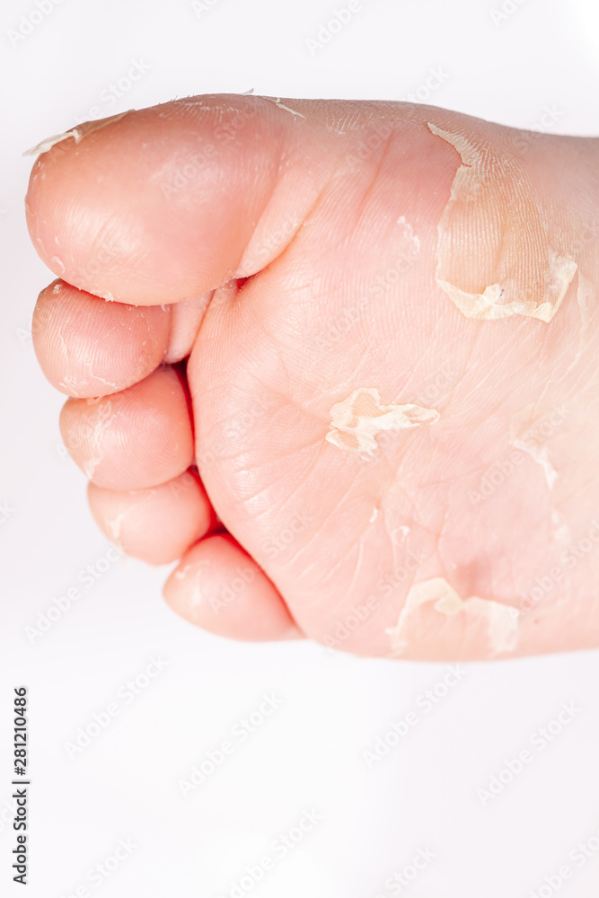 After the red rash and the strawberry tongue caused by scarlet fever the affected skin often peels - Here Skin of foot peeling After the red rash and the strawberry tongue caused by scarlet fever the affected skin often peels - Here Skin of foot peeling