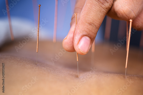 Close-up of senior female back with steel needles during procedure of acupuncture therapy