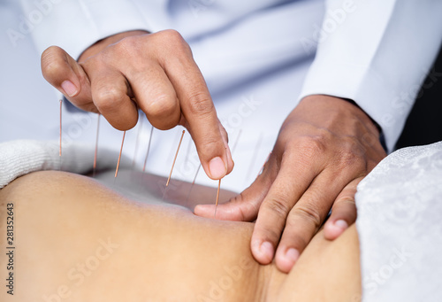 Cuadro en lienzo Close-up of senior female back with steel needles during procedure of acupunctur