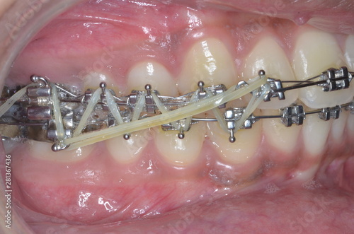 braces treatment for male teeth