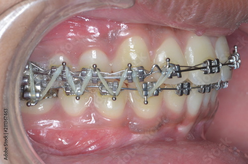 braces treatment for male teeth