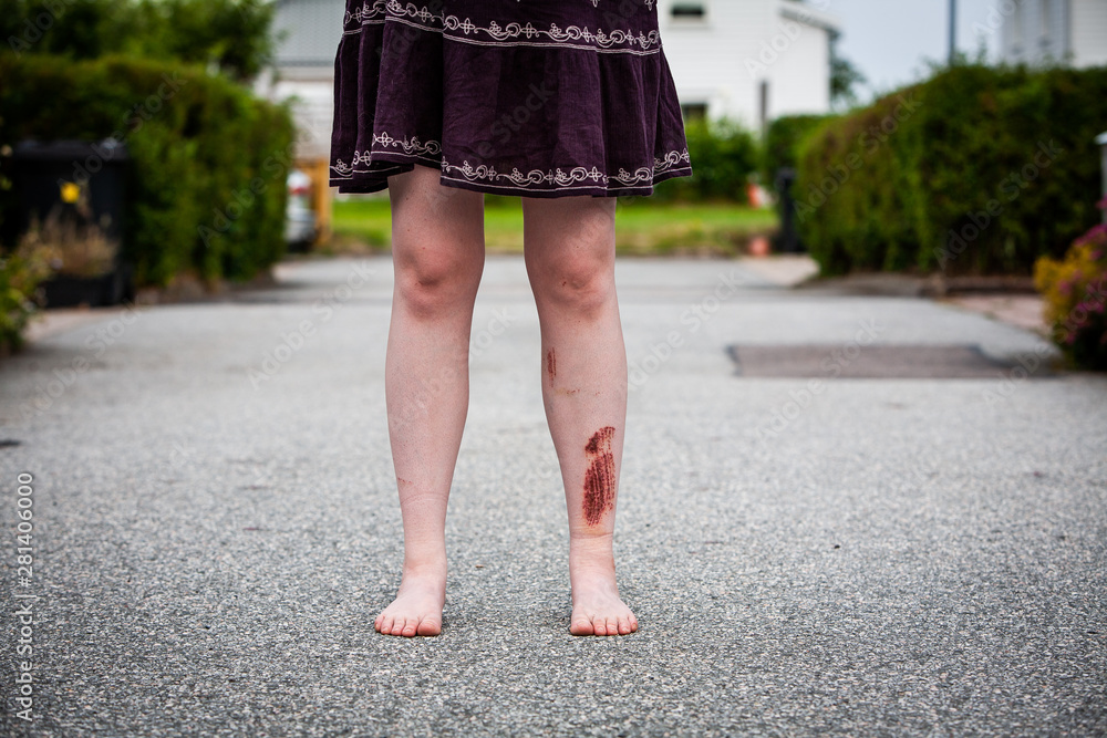 A young woman is standing in the road with bare feet, seen from the front. She has an injury on her leg (shin) that is 3 days healed. A big scab has formed after a falling accident. A young woman is standing in the road with bare feet, seen from the front. She has an injury on her leg (shin) that is 3 days healed. A big scab has formed after a falling accident.