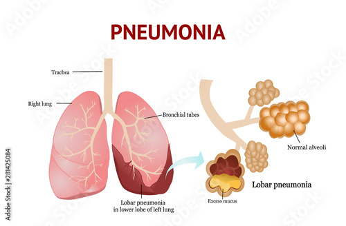 Pneumonia, Lobar pneumonia, isolated vector illustration on White background.