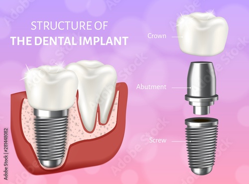 Vector illustration depicting the structure of the dental implant. Design concept of the dental implant process.