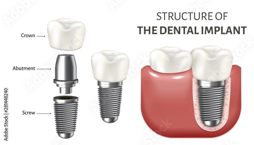 Medical vector illustration showing a structure of the dental implant. Realistic image isolated on the white background.